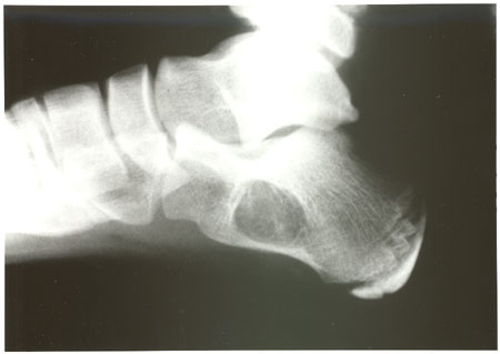 Figure 1. Observe the geographic lytic expansile lesion present in the floor of the calcaneus.