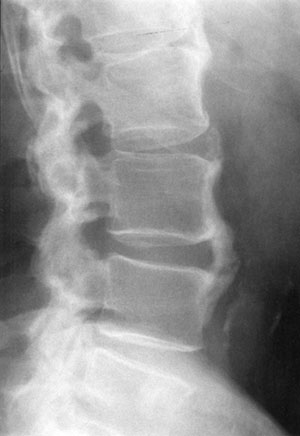 Observe the thick flowing hyperostosis projecting from the anterior vertebral bodies of L1 through L4. This is characteristic of DISH.