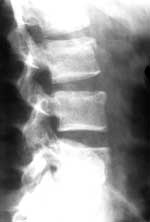Compression fracture of L2 and L4 superior vertebral endplates. Observe the