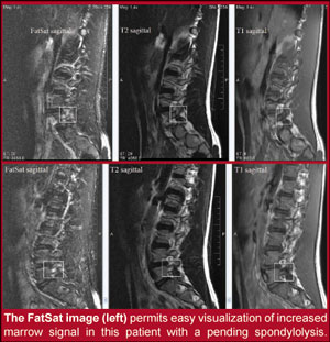 SPONDYLOLYSIS AND/OR SPONDYLOLISTHESIS:  LET’S GET IT RIGHT AND STIR THINGS UP