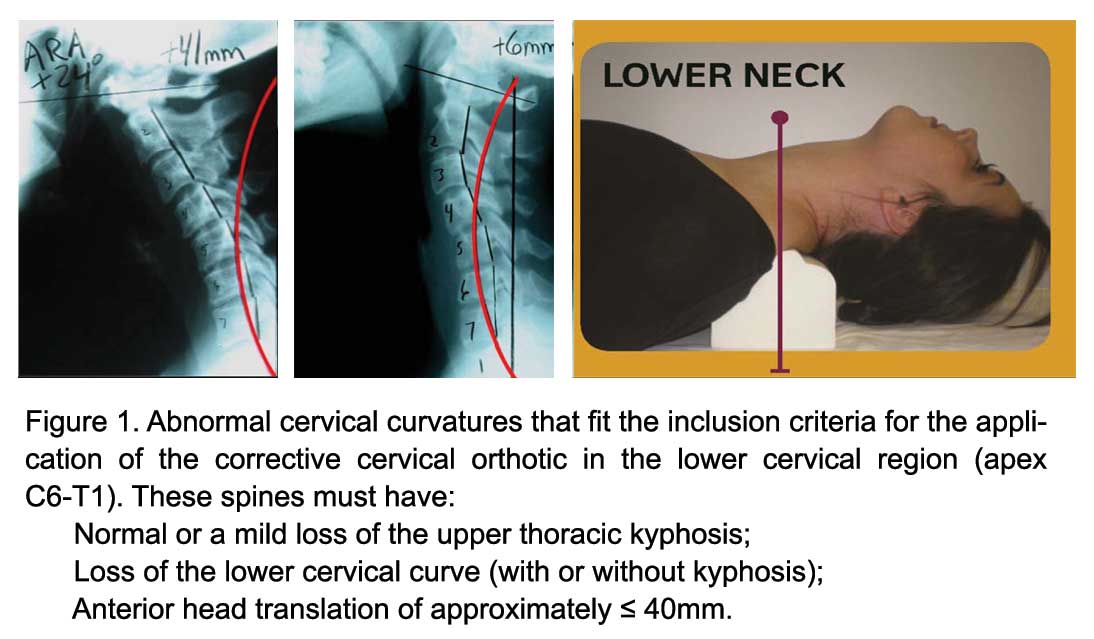 Appropriate Use of a Cervical Orthotic for Abnormalities of the Cervical Lordosis