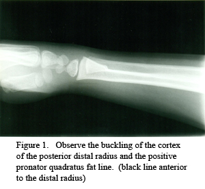 Fracture of the Wrist Affecting the Young and Old