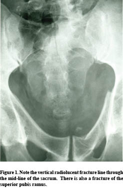 Sacral and Coccygeal Fractures
